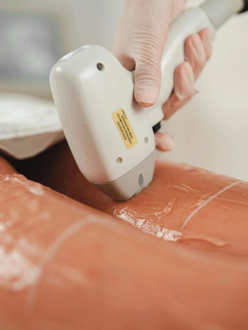 Épilation laser sur la jambe